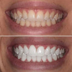 Dentifrice Blanchissant  ( Glory smille)
